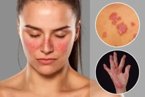 Lupus in USA
